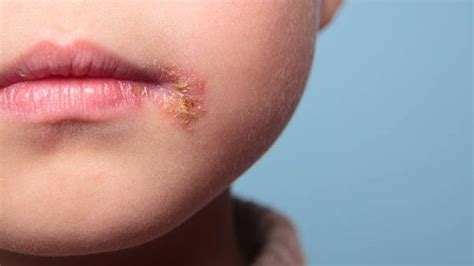 herpes labial en niños